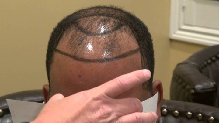 black receding hairline